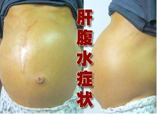 阳痿容易反复产生的原因